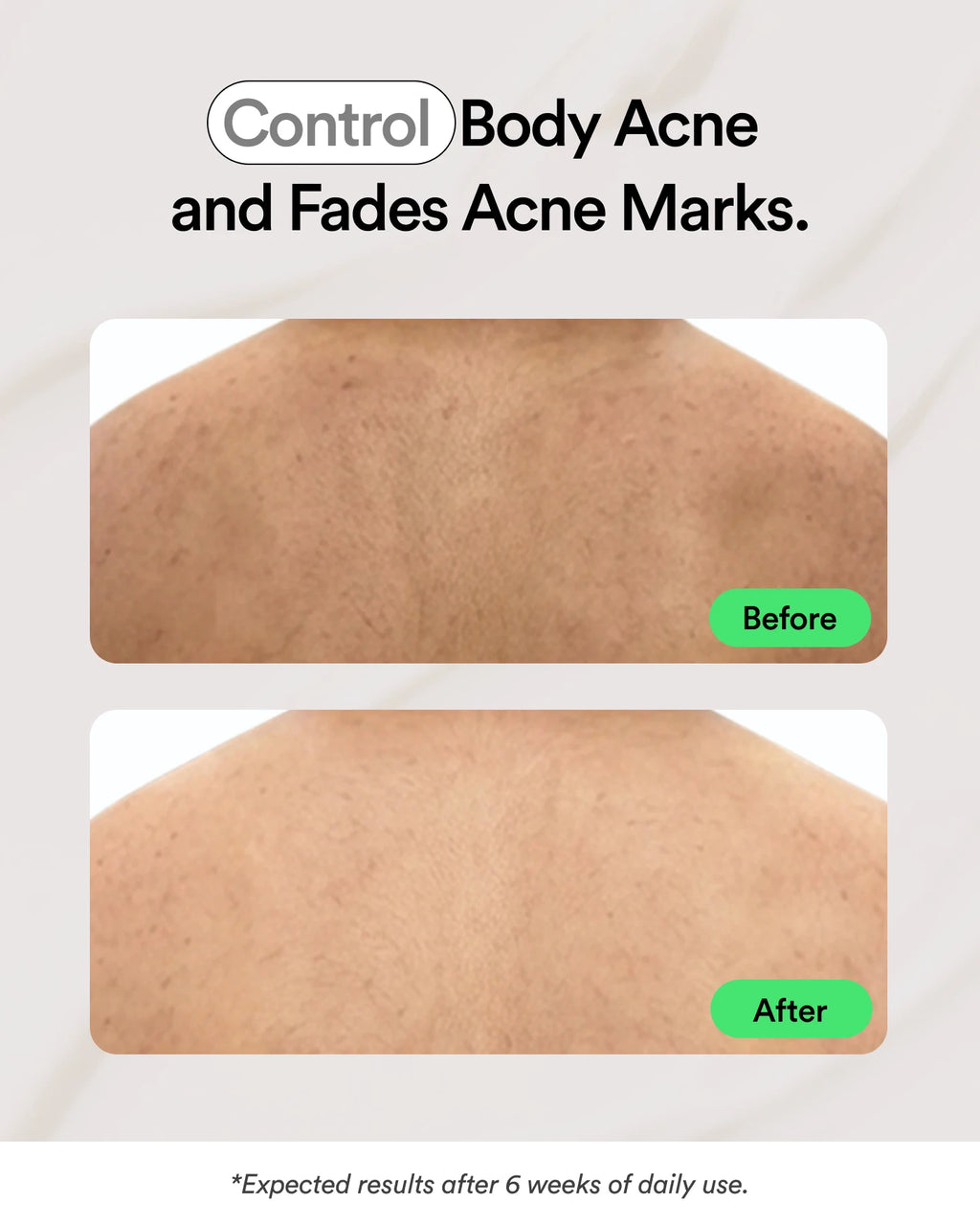 Acne Control Body Spray