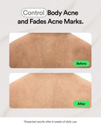 Acne Control Body Spray