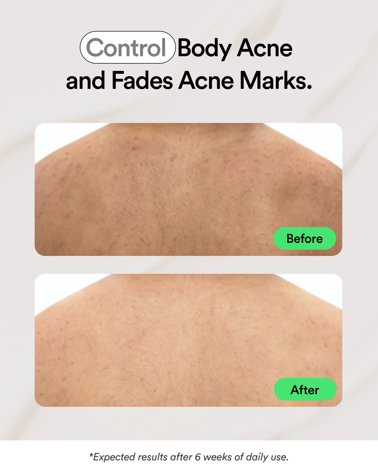 Acne Control Body Spray