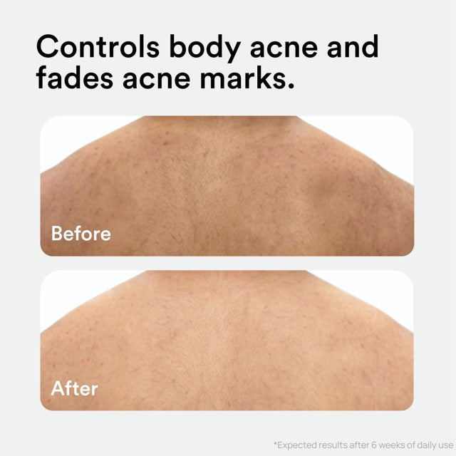 Acne Control Body Spray
